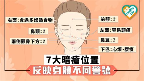 鼻梁生暗瘡|【暗瘡位置】不同代表什麼？中醫教如何處理及預防